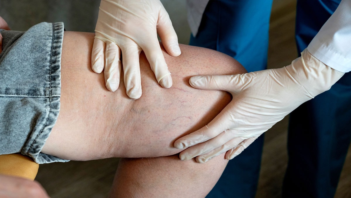 Bacaklardaki sişkinliklerin bir nedeni de Lipodem